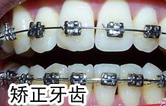Straightening Teeth | ChinesePod